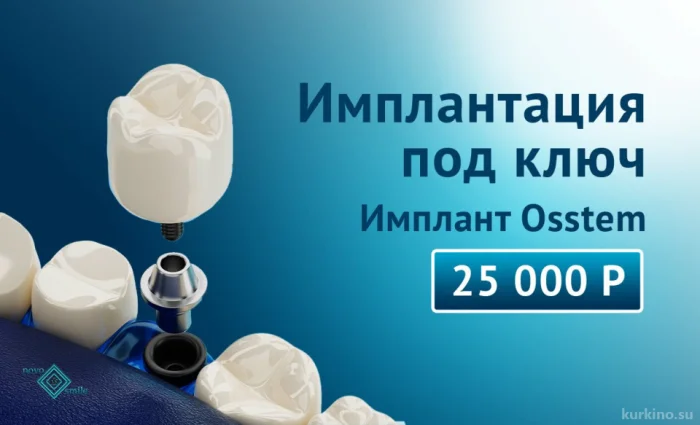 Имплантация под ключ. Имплант Osstem 25 000 руб.